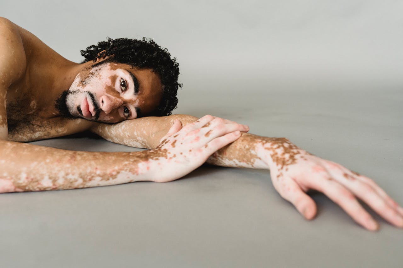 A charismatic young man embracing his vitiligo indoors, showcasing body positivity.