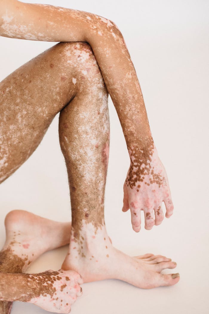Crop anonymous ethnic male with bare legs living with vitiligo condition sitting on floor against white wall in studio