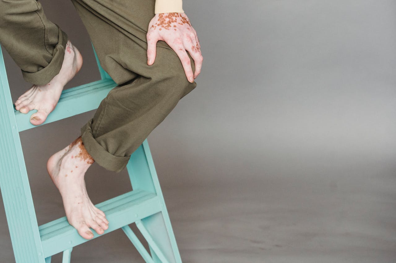 A person with vitiligo sitting barefoot on a teal ladder indoors.